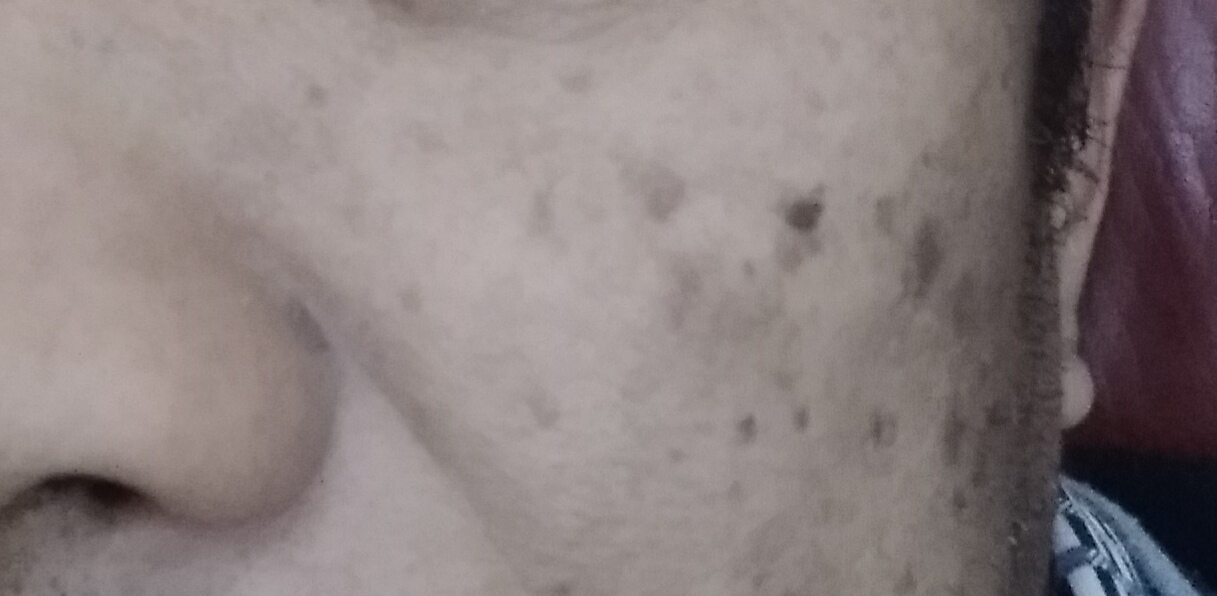 油溅到脸上有黑斑多久消失图片,40多岁脸上起黑斑是怎么回事