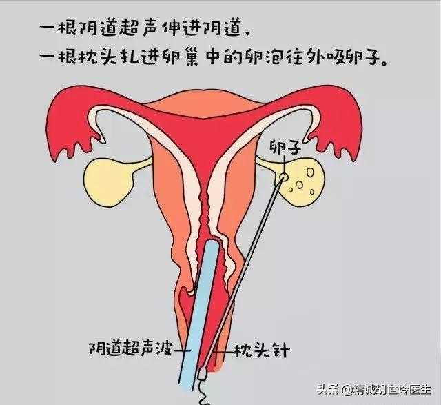 取完卵没有腹水多久可以移植冻胚,取了26个卵没腹水能移植吗
