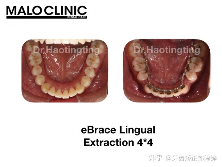 上海成人牙齿矫正失败案例,上海牙齿矫正郝婷婷医生