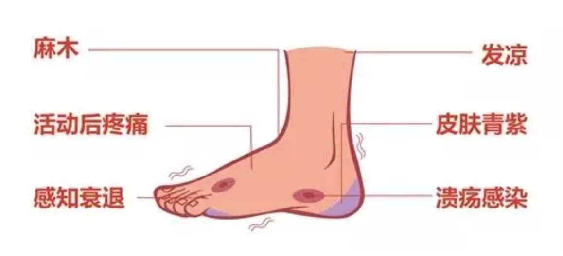 3d打印糖尿病鞋中底,糖尿病足专用鞋