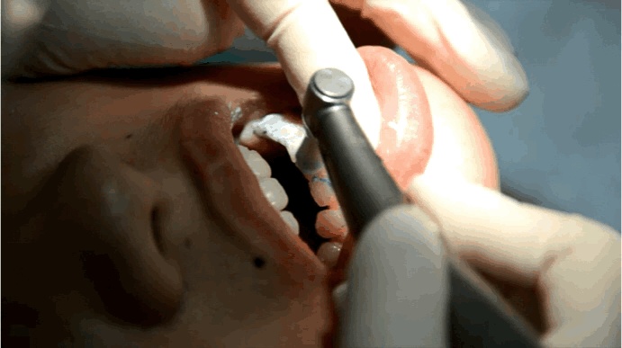 牙齿后面的白色脏东西怎么去除,牙齿内侧一层黄黄的怎么洗掉