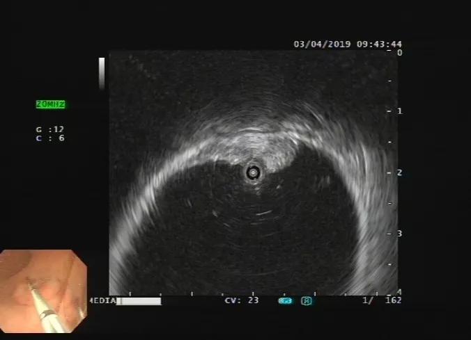 消化内镜发展现状,上消化道超声内镜临床应用