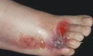 小小脚气危害大，春季正高发，孕妈中招能用药吗？