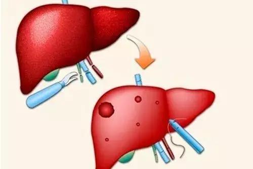 肝囊肿要治疗吗什么原因引起,肝囊肿14x13mm要不要紧