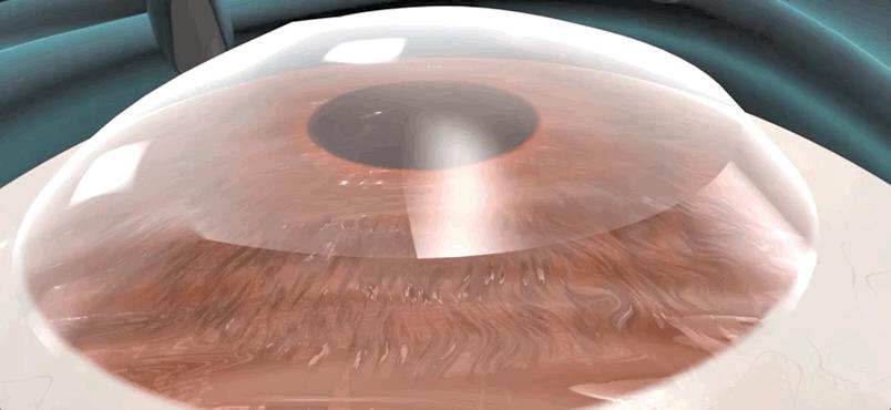 激光治疗近视什么原理,激光矫正是什么原理