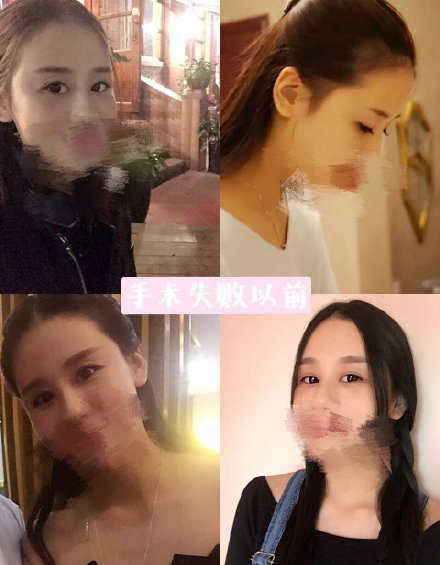 双眼皮手术后眼神凶狠是什么原因,双眼皮手术后显凶