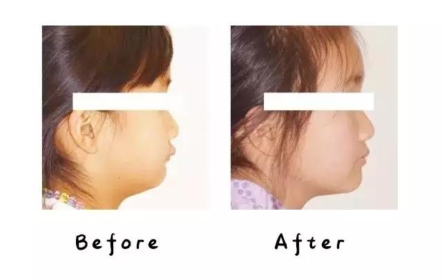 mrc矫正器小孩子晚上不愿意咬,mrc儿童牙齿矫正