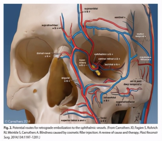 打玻尿酸多久可以移植自体脂肪,打玻尿酸整形有危险吗
