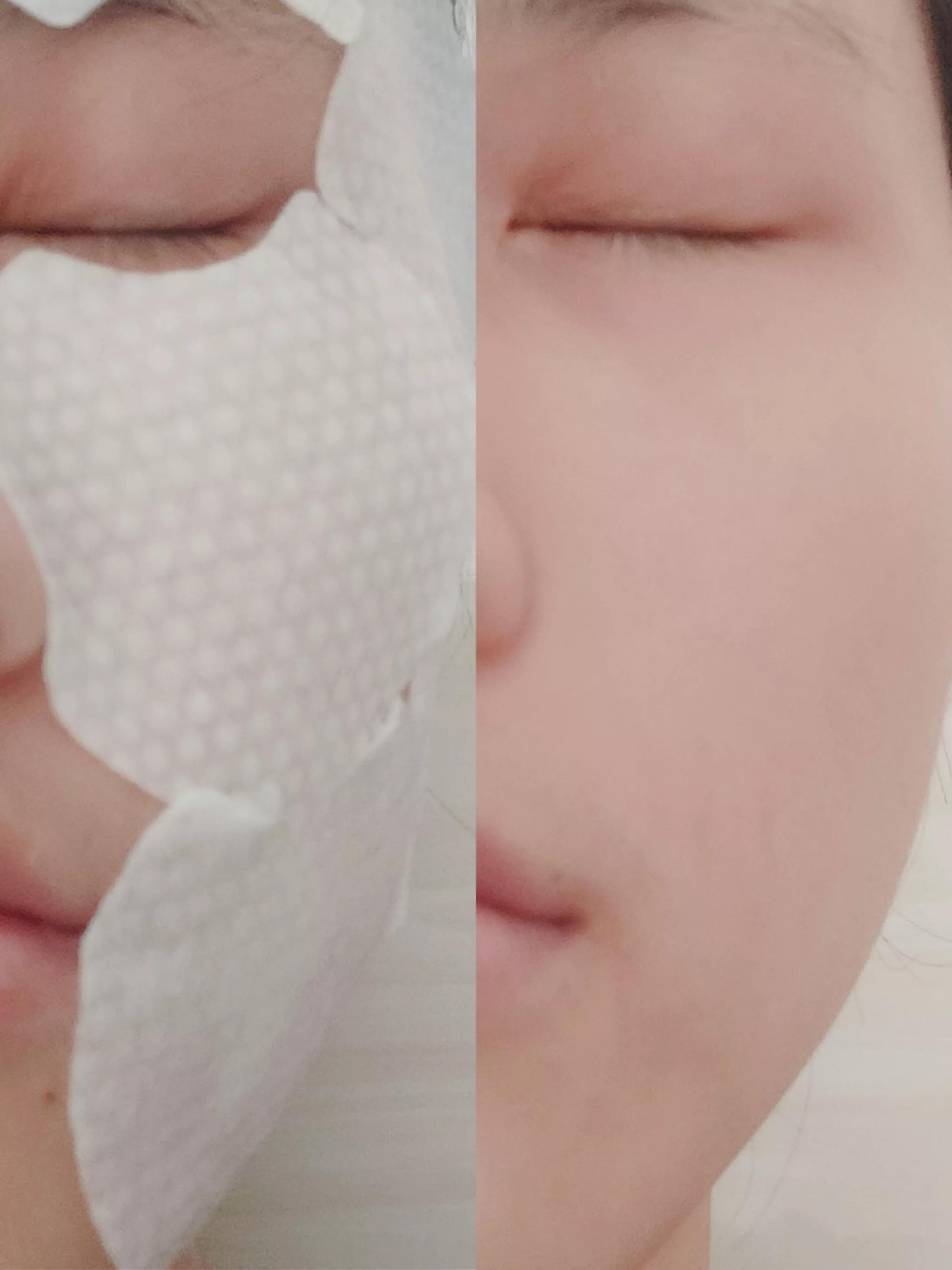 闭口粉刺痘痘反复发作怎么去根,如何快速祛痘痘