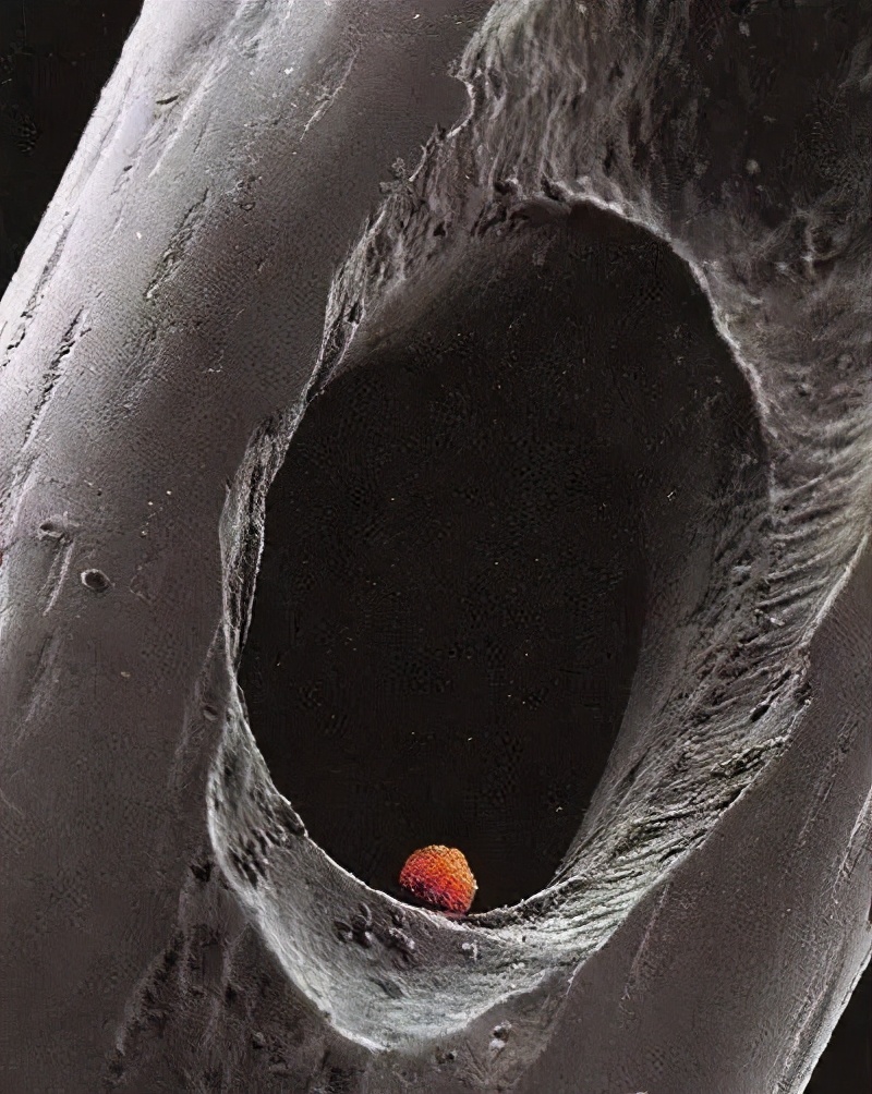 移植便秘用力拉会把胚胎拉出来吗,移植后便秘用力上厕所了有影响吗