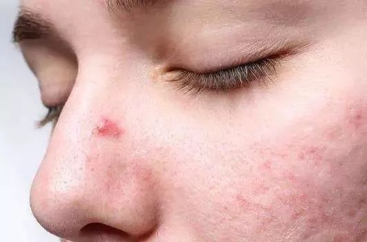 脸上螨虫多出油厉害怎么办,脸上螨虫过敏烂脸