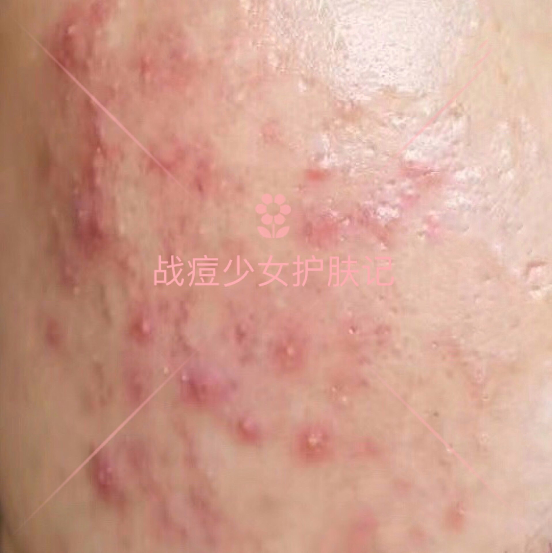 四招解决痘痘及痘痘的成因,痘痘不同原因类型及处理方法