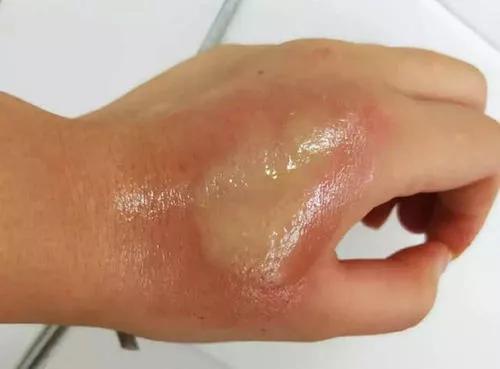 小时候被洋辣子扎过,小时候被洋辣子蛰