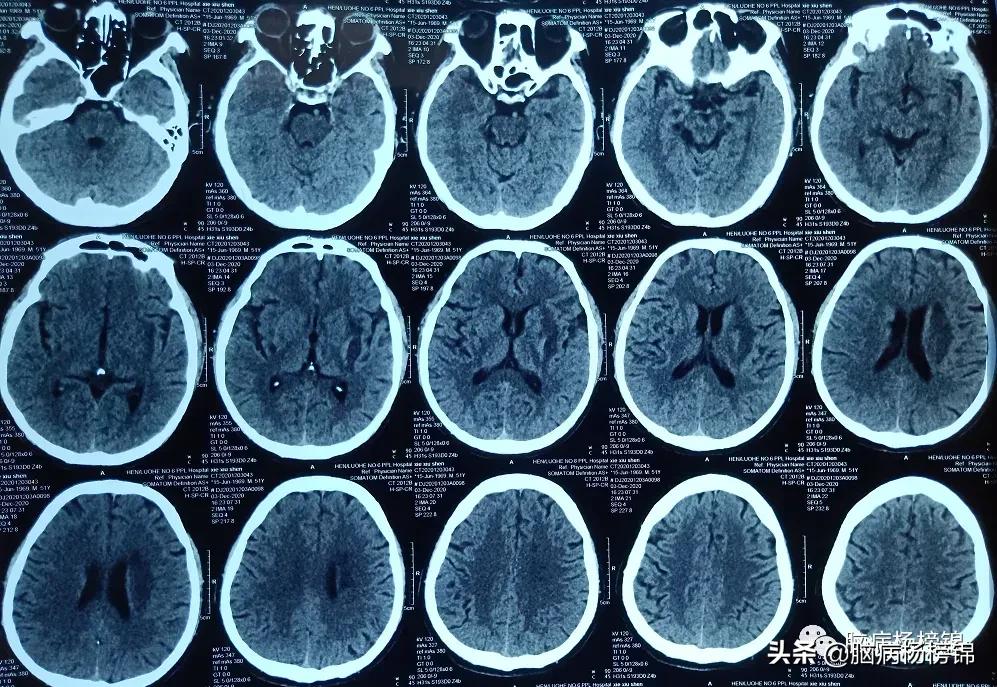 高处坠落4-6小时导致脑出血,高空作业会不会引起脑出血
