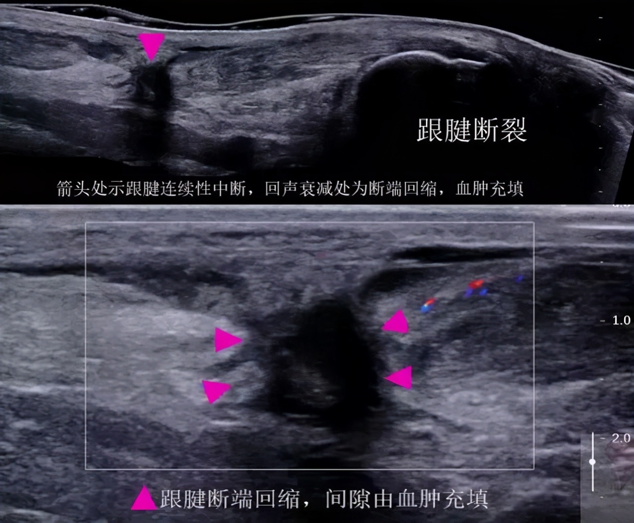 如何防止跟腱断裂和膝盖受伤,怎么避免跟腱断裂田径