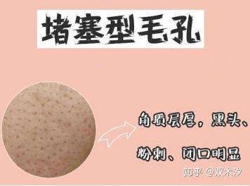 几种类型毛孔粗大改善的方法,毛孔粗大如何用科学方法改变