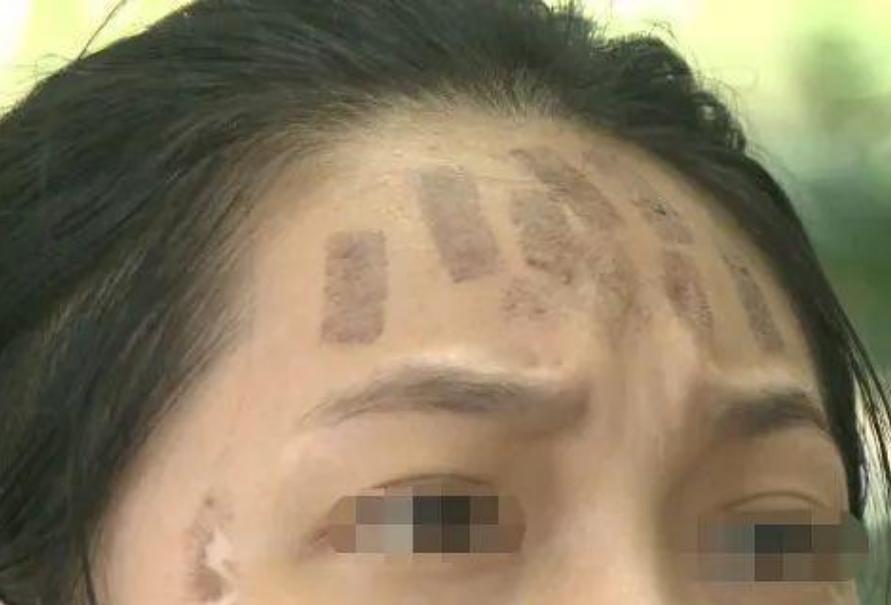 女子做完光子嫩肤后脸上全是黑疤,做完光子嫩肤后怎么黑了