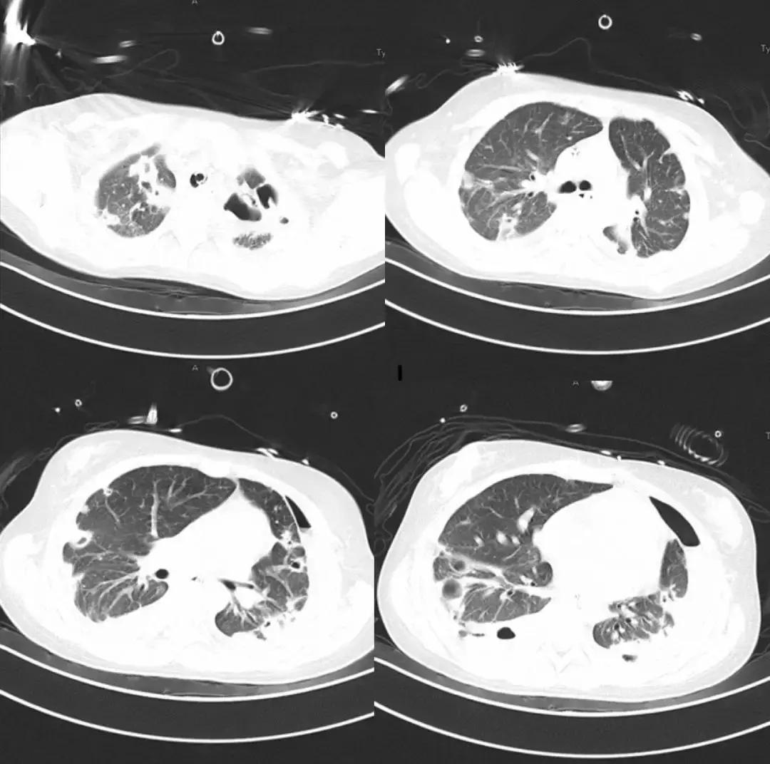 万古霉素用于mrsa的作用机制,万古霉素无效还有什么抗生素可用
