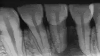 做根管治疗一定要问的问题,根管治疗为啥要做好几次