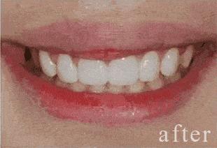 牙齿美白祛黄神器好评语,牙齿祛黄美白用什么产品比较好