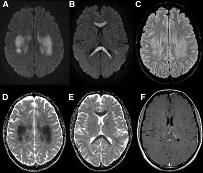 胼胝体有什么症状,胼胝体形态较小可以治疗吗