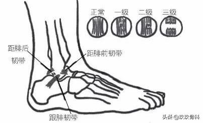 习惯性脚踝扭伤3年怎么治疗,习惯性扭伤脚踝隐隐作痛