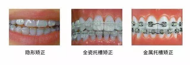 戴一个牙套会掉吗,戴个牙套对嘴唇有变化吗