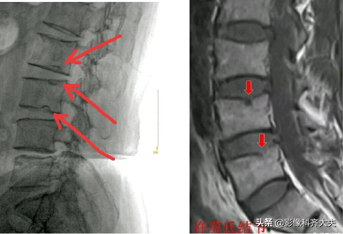 腰椎间盘突出最好的影像诊断方法,腰椎间盘突出的影像学检查