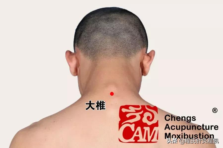 腰疼寒气重外敷处方,受寒腰痛可以拔火罐