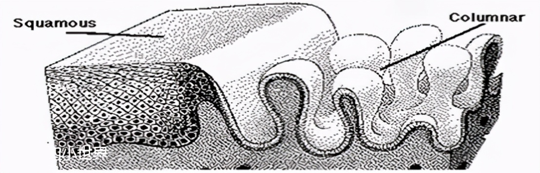 你知道宫颈糜烂的危害是什么吗,宫颈糜烂不是病别再被忽悠了