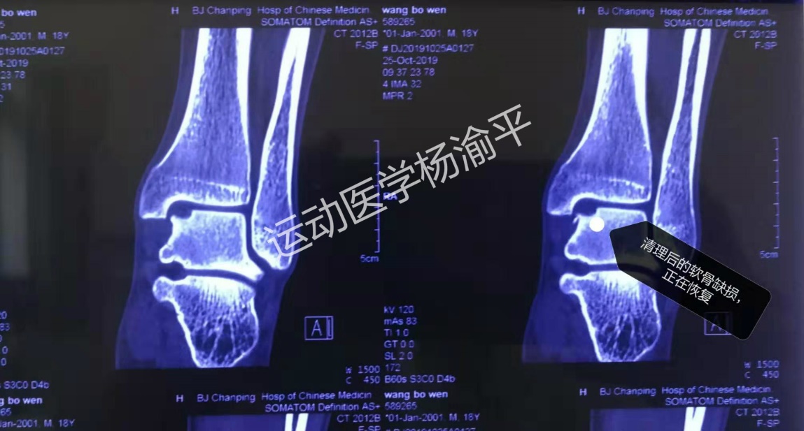 脚崴伤软骨损伤3年了如何治疗,崴脚轻度损伤需要恢复几天