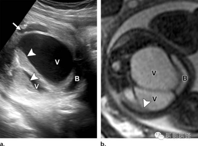 胎儿卵巢囊肿5.6厘米会消失吗,卵巢巨大囊肿与妊娠鉴别