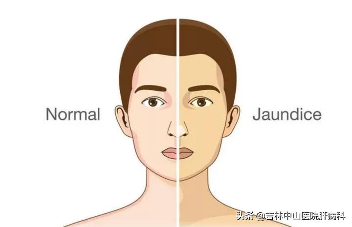 胆囊炎胆红素升高,胆红素升高怎么办呢