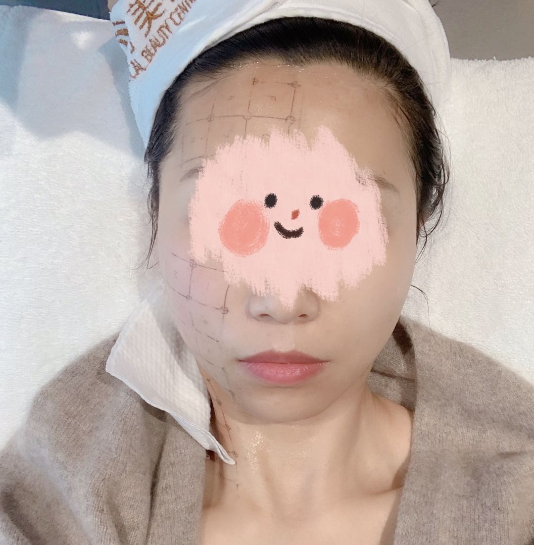 抽血都怕疼,39岁做热玛吉