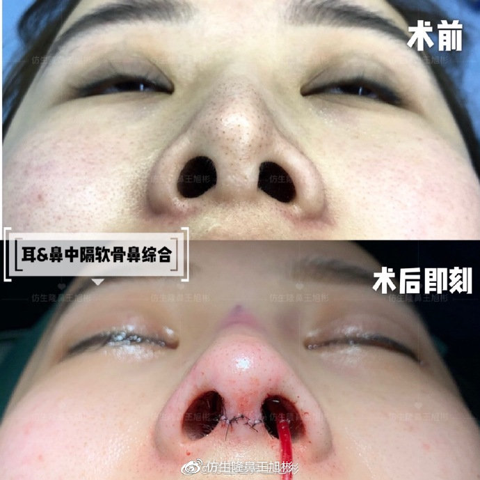 假体隆鼻耳软骨垫鼻尖图片,l型假体耳软骨隆鼻图片