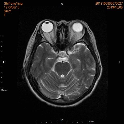肺神经内分泌癌早期手术好吗,肺部神经内分泌肿瘤治疗