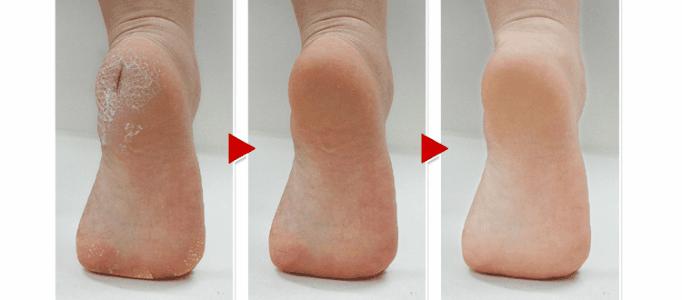 为什么汗脚特别臭,汗脚突然变干脚裂口什么原因