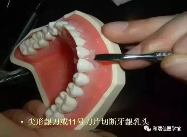 松牙固定需要什么条件,钢丝松牙固定操作流程