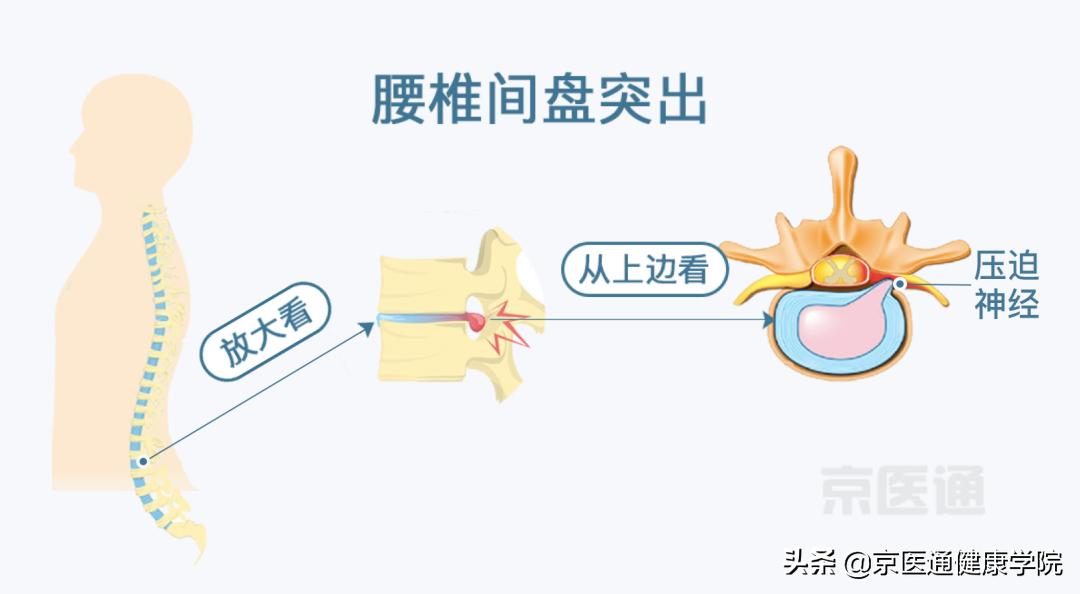 腰痛骨科怎么治疗,腰痛腿痛有什么特效药