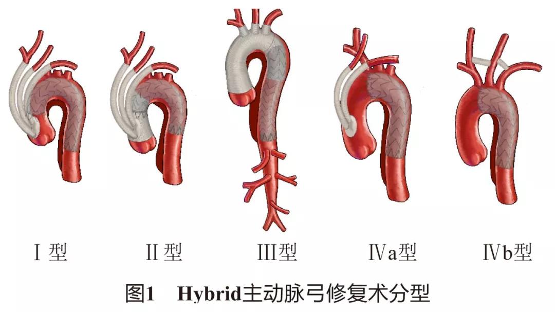 杂交疗法,主动脉杂交手术适应症