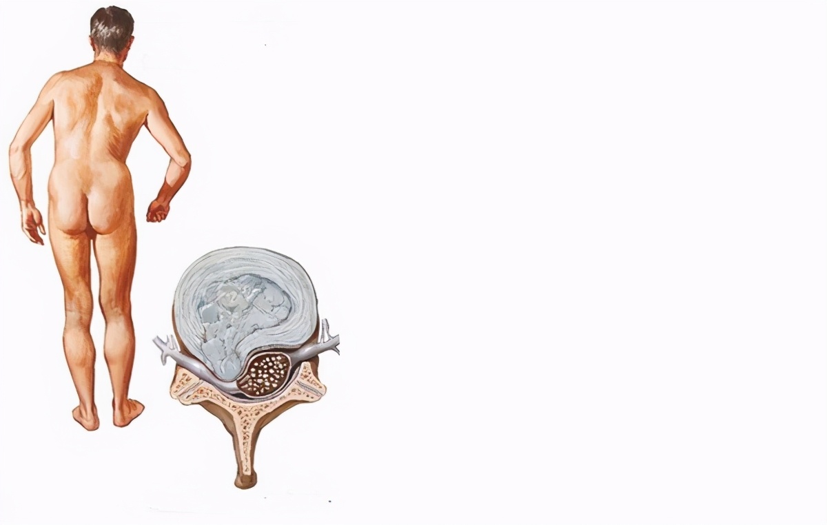 得了腰椎间盘突出症是不是人就废了,得了腰椎间盘突出症状怎么消失