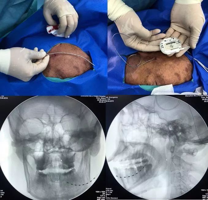 坐骨神经痛是糖尿病引起的吗,被糖尿病并发症吓到