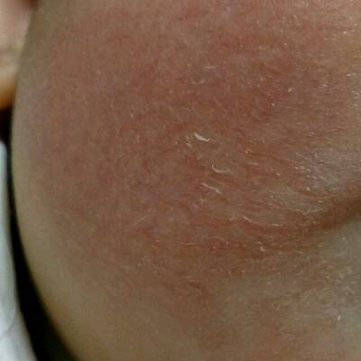 孩子皮肤干燥起皮怎么回事,孩子皮肤干燥起皮什么原因