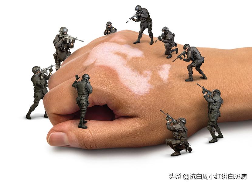 白癜风不治疗有可能自愈吗,白癜风不治疗会一直发展吗