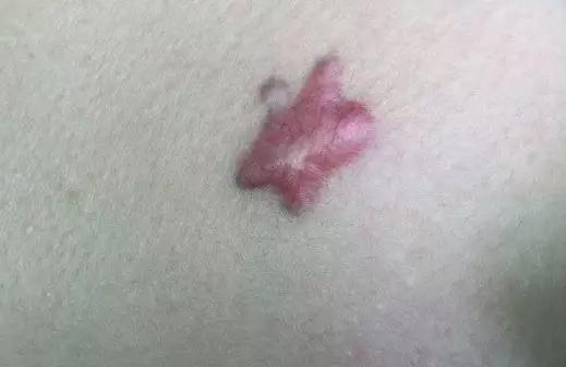 欣奕除疤凝胶对疤痕体质有效果吗,疤痕形成后用芦荟能除疤吗