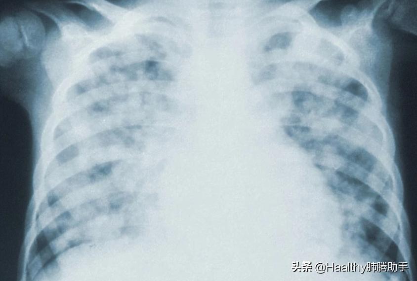 十大注意事项让肺癌患者活得更久,肺癌少遭罪又有效的治疗方法