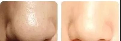 从科学角度看黑头能快速根除吗,重度黑头怎样彻底去除