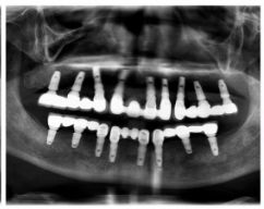 满口缺牙如何补牙,满口缺牙怎么办