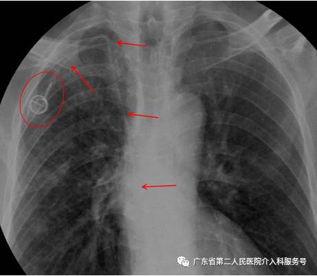 输液港能多次做吗,输液港可以重复使用吗