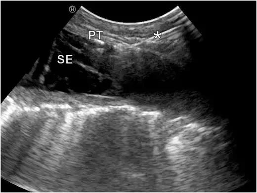 胸部超声引导下穿刺活检术流程,ct引导下肺穿刺活检优缺点